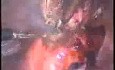 Laparoscopic Polymyomectomy