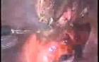 Laparoscopic Polymyomectomy