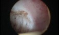 Diagnosing and Treating Repeated Miscarriages - Septate Uterus