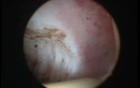 Diagnosing and Treating Repeated Miscarriages - Septate Uterus