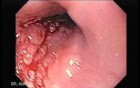 Esophageal Squamous Cell Carcinoma - Visualization of Esophageal Mucosa and Tumor