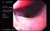 Banding of Esophageal Varices - Appearance of Typical Varices