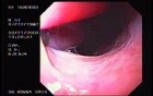 Banding of Esophageal Varices - Appearance of Typical Varices
