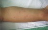 Urticaria