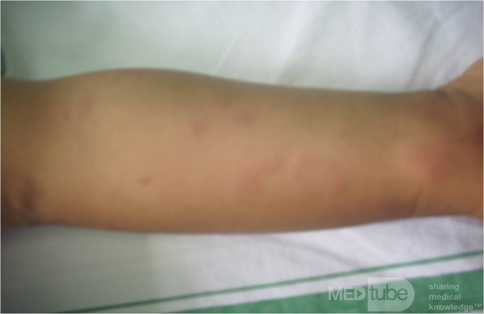 Urticaria