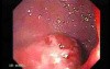 Multiple Adenomatous Polyps Of The Rectum (4 of 37)