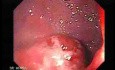 Multiple Adenomatous Polyps Of The Rectum (4 of 37)