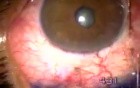 Failed Transciliary Filtration - Resurgery