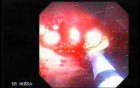 Upper Gastrointestinal Tract - Bleeding (5 of 7)