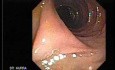 Stalked Polyp - Polypectomy (2 of 6)