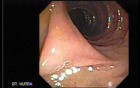 Stalked Polyp - Polypectomy (2 of 6)