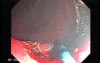 Tubulo - Villous Rectal Adenoma - Endoscopy (22 of 35)