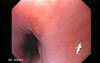 Esophageal Diverticula - Heterotopic Gastric Mucosa