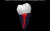 Mandibular Third Molar