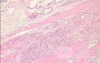 Adenocarcinoma of the cardias and gastric fundus with signet-ring cells (19 of 25)