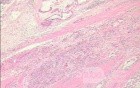 Adenocarcinoma of the cardias and gastric fundus with signet-ring cells (19 of 25)