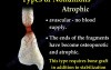 Causes and Treatment of Nonunion Fractures