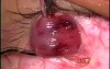 Fugo Blade - inferior oblique myomectomy