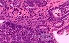 Heterotopic Pancreas with large Central Hole (6 of 6)