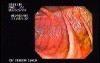 Familial Adenomatous Polyposis of the Colon (4 of 29)
