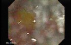 Schistosoma Mansoni in the Cecum (5 of 9)