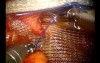 Robotic TAPP with Ventral Hernia