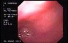 Barret´s Esophagus long segment (4 of 4)