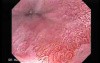 Gastric Heterotopia (inlet pach) (2 of 4)