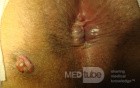 Fistula in Ano (2 of 7)