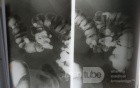 Barium Enema - Diverticulosis