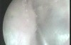 post operative Mrm 4Years