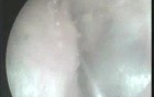post operative Mrm 4Years