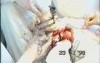 Right Pneumonectomy
