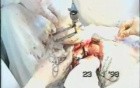 Right Pneumonectomy