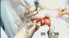 Right Pneumonectomy
