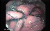 Multiple Irregular and Large Ulcers - Biopsy nr 4