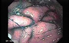 Multiple Irregular and Large Ulcers - Biopsy nr 4