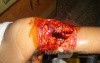 Blunt Injury Of The Arm