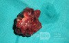 Giant Multilobulated Gastric Polyp (16 of 20)