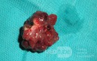 Giant Multilobulated Gastric Polyp (16 of 20)