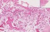 Acute Fibrinous Pericarditis