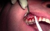Tunneling Technique - Gingival Grafting #3-6 Sites