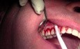 Tunneling Technique - Gingival Grafting #3-6 Sites
