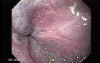 Alcoholic Cirrhosis - Presence of Scars After Eradication of Esophageal Varices, Part 1