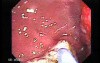 Multiple Adenomatous Polyps Of The Rectum (10 of 37)