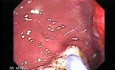 Multiple Adenomatous Polyps Of The Rectum (10 of 37)