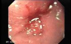 Adenocarcinoma of the middle third (2 of 5 )