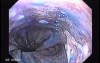 Barrett Esophagus - chromoendoscopy using methylene blue (6 of 6)