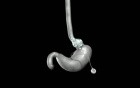Gastric Band Animation