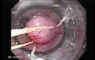 Severe Bleeding of the Upper Digestive System After Two Days of Band Ligation - Variceal Ligation, Part 2